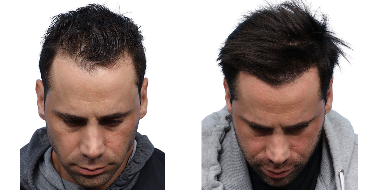 FUE Hair Transplant Before & After Gallery - Patient 202402 - Image 2