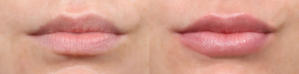 Lip Enhancement Before & After Gallery - Patient 385114 - Image 1