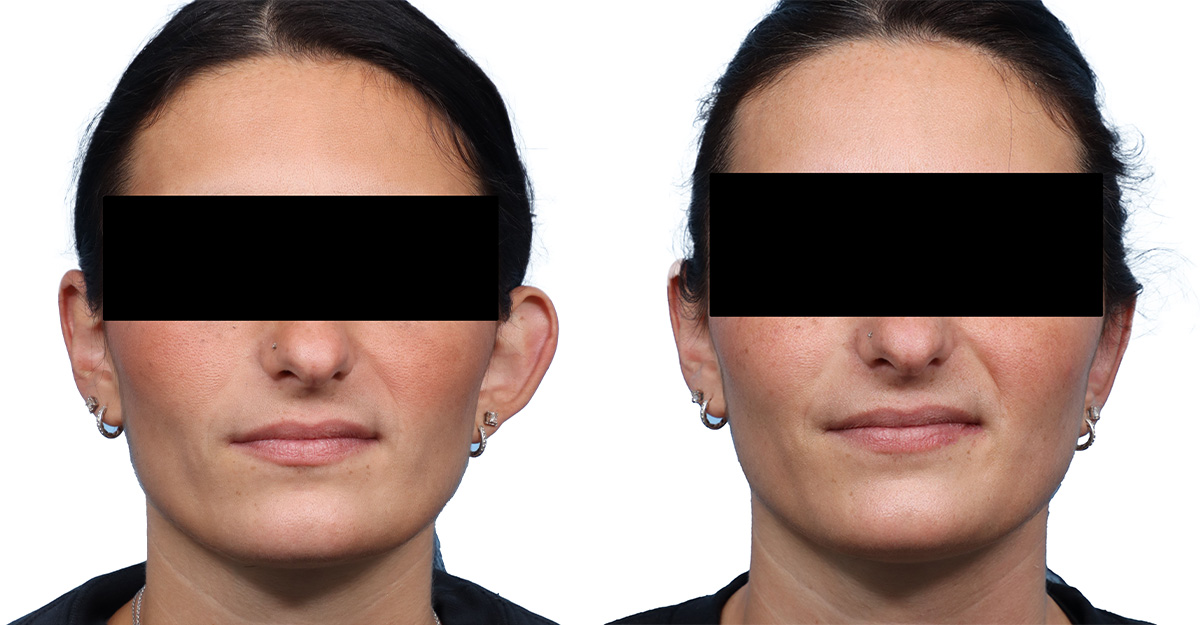 Otoplasty (Ear Surgery) Before & After Gallery - Patient 114465 - Image 1