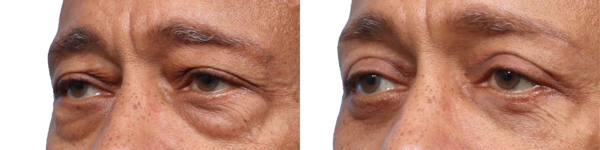Blepharoplasty (Eyelid Surgery) Before & After Gallery - Patient 175742 - Image 2