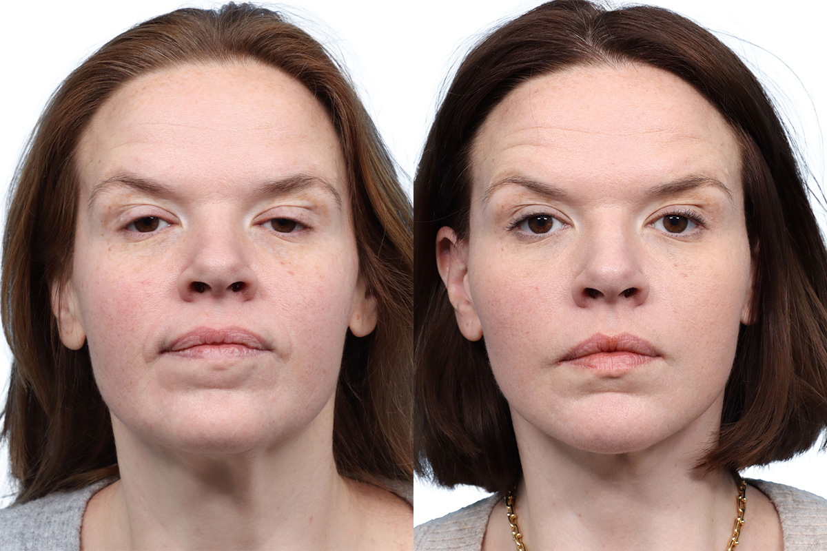 Facial Fat Transfer Before & After Gallery - Patient 184501 - Image 1