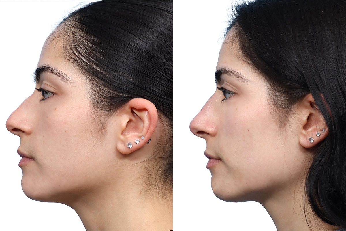 Non-Surgical Rhinoplasty Before & After Gallery - Patient 267926 - Image 2
