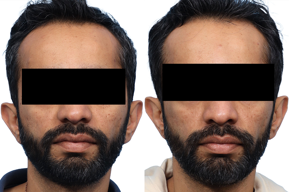 Lutronic Ultra Before & After Gallery - Patient 189866 - Image 3