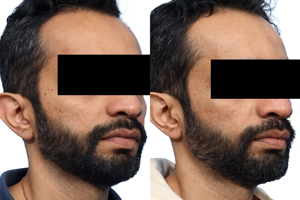 Lutronic Ultra Before & After Gallery - Patient 189866 - Image 1