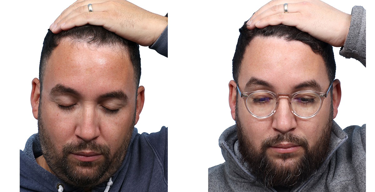 FUE Hair Transplant Before & After Gallery - Patient 357341 - Image 3