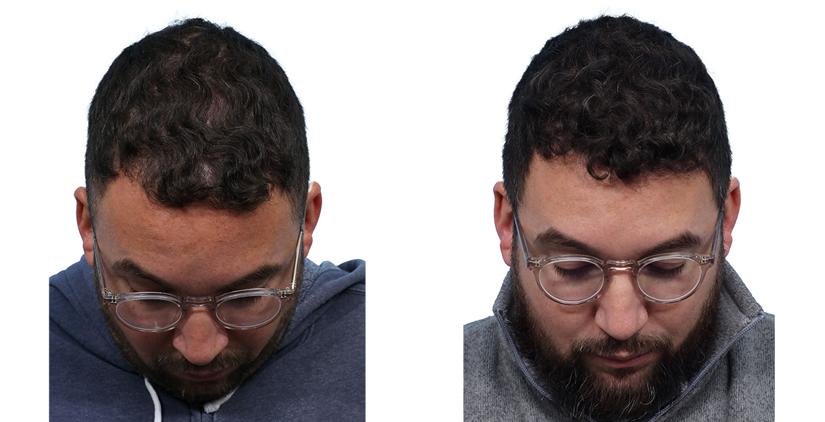 FUE Hair Transplant Before & After Gallery - Patient 357341 - Image 2