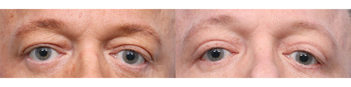 Blepharoplasty (Eyelid Surgery) Before & After Gallery - Patient 121103 - Image 1