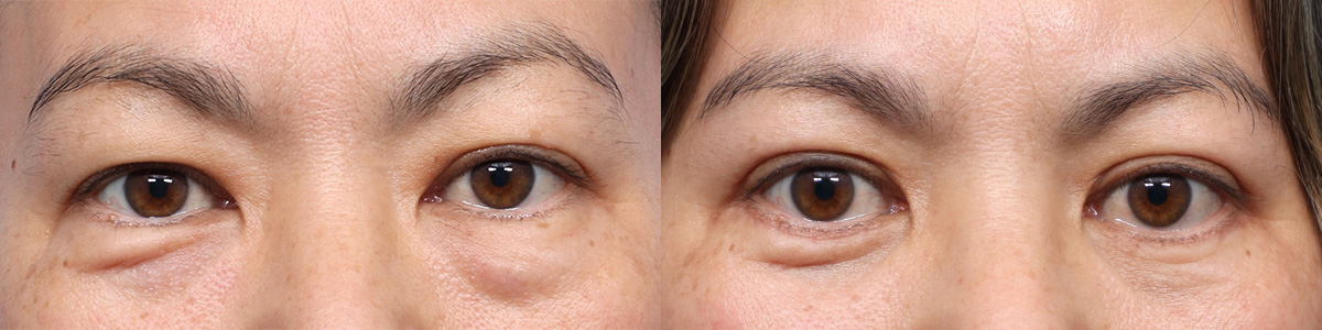 Blepharoplasty (Eyelid Surgery) Before & After Gallery - Patient 370494 - Image 1