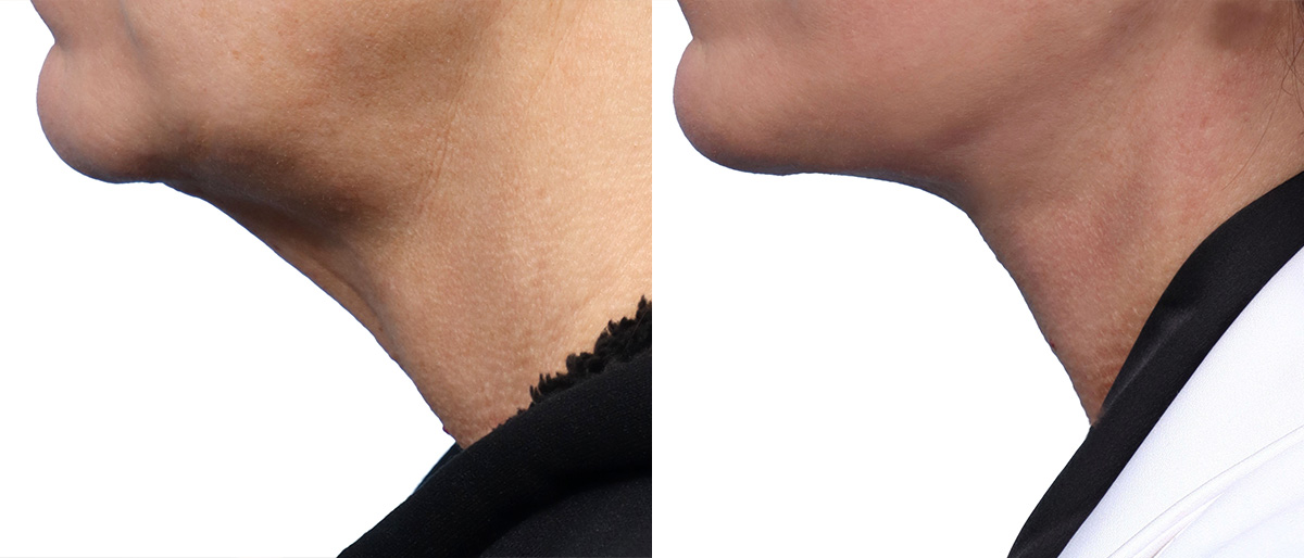 Deep Plane Facelift Before & After Gallery - Patient 146439 - Image 3