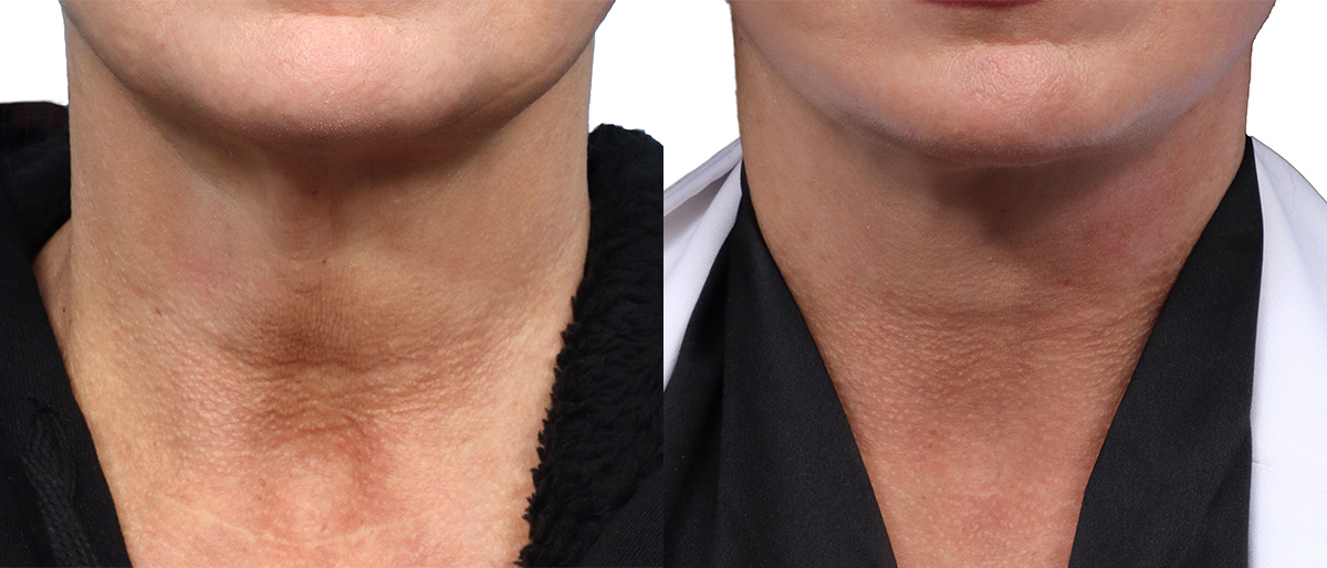 Deep Plane Facelift Before & After Gallery - Patient 146439 - Image 1