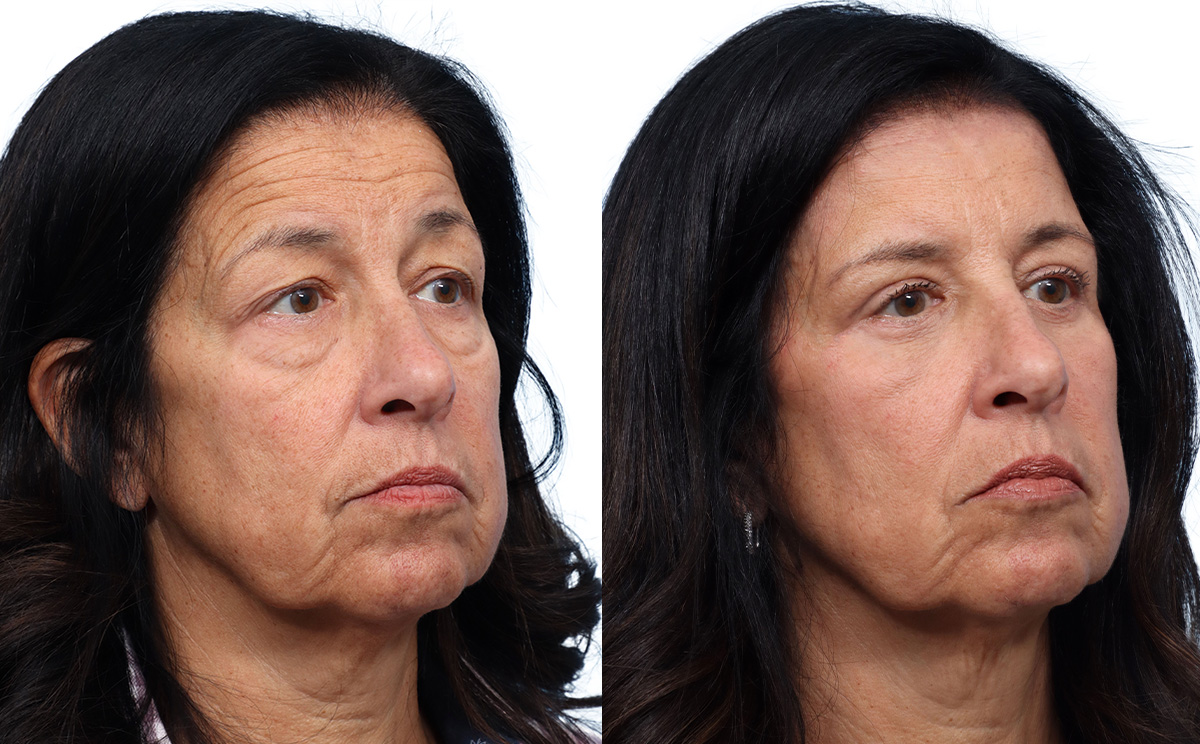 Blepharoplasty (Eyelid Surgery) Before & After Gallery - Patient 134925 - Image 2