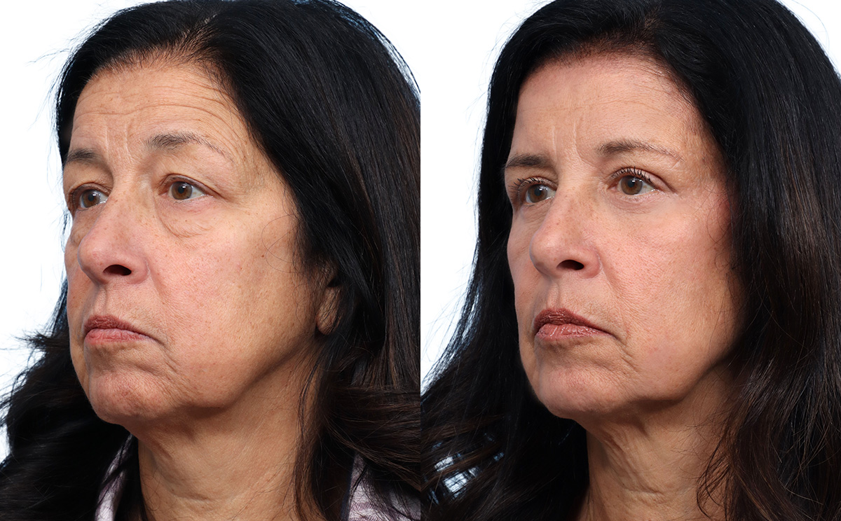 Blepharoplasty (Eyelid Surgery) Before & After Gallery - Patient 134925 - Image 3