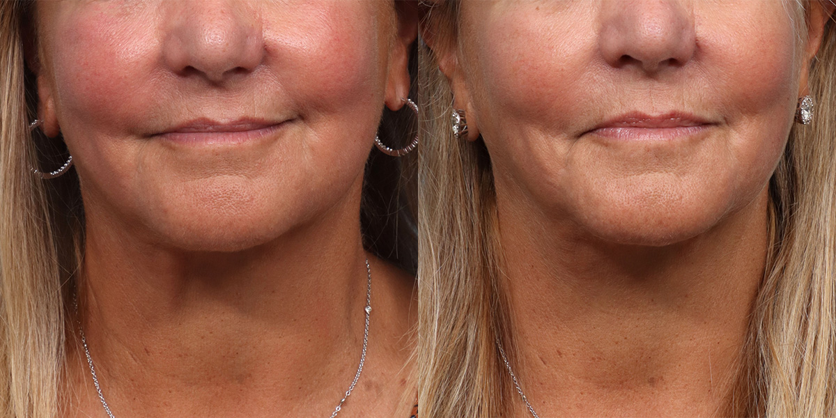 Ultherapy before and after