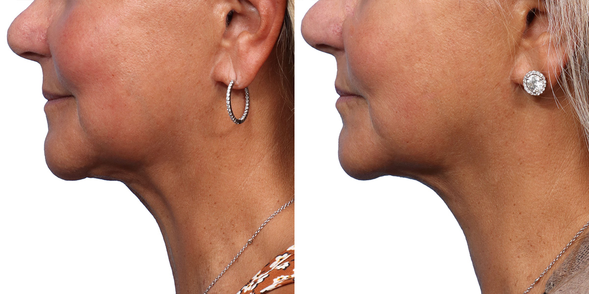 Ultherapy® Before & After Gallery - Patient 355705 - Image 3