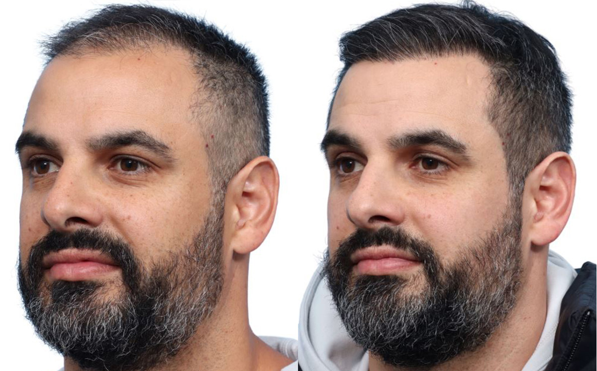 FUE Hair Transplant Before & After Gallery - Patient 190441 - Image 4