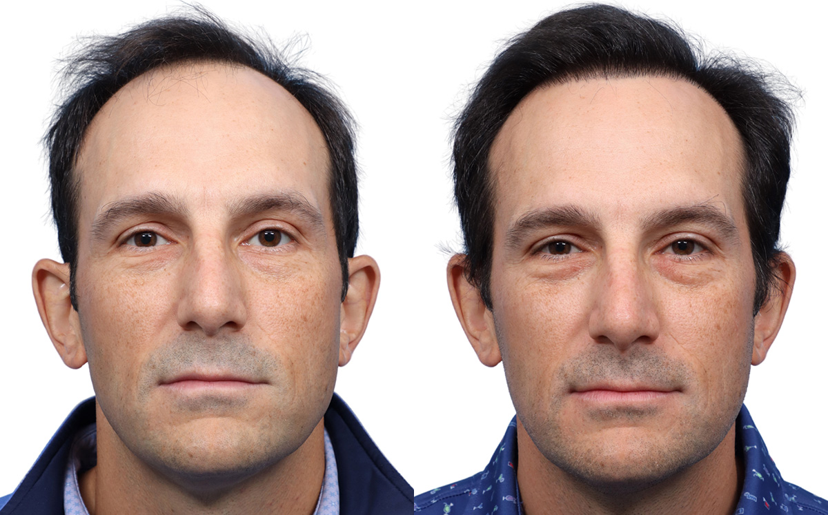 FUE Hair Transplant Before & After Gallery - Patient 113936 - Image 1