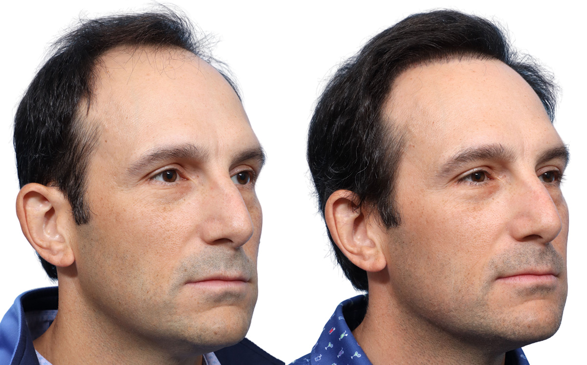 FUE Hair Transplant Before & After Gallery - Patient 113936 - Image 3