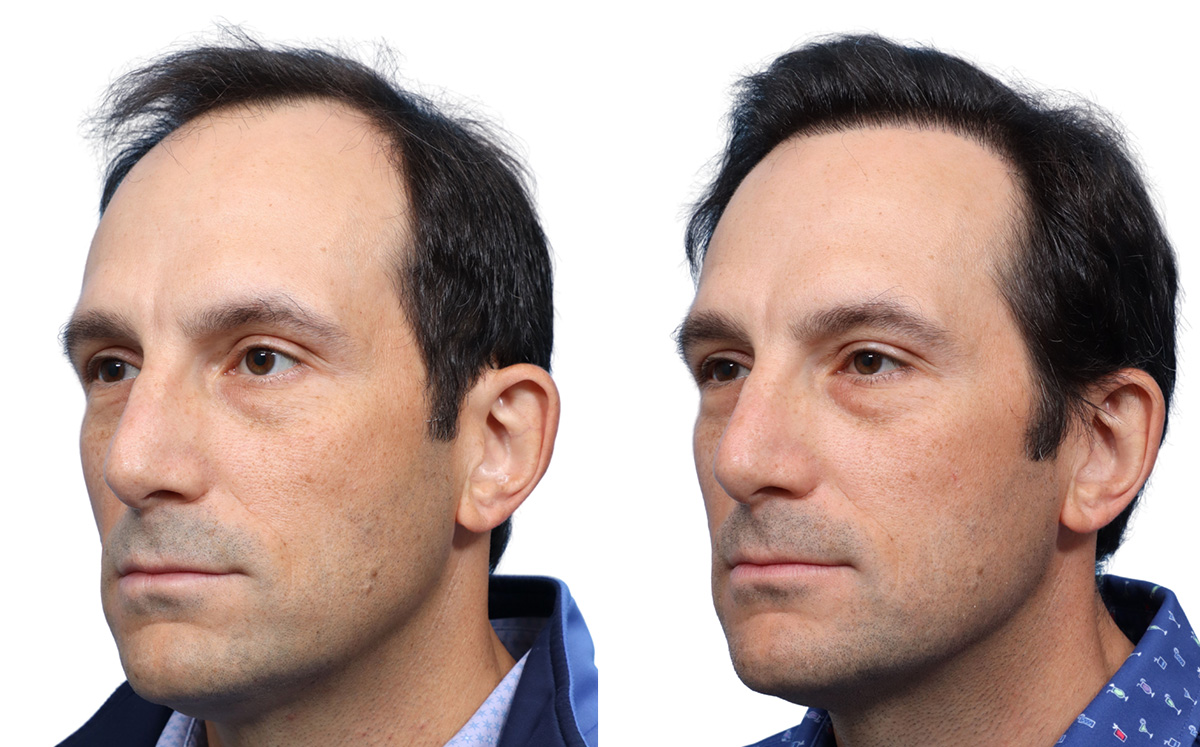 FUE Hair Transplant Before & After Gallery - Patient 113936 - Image 4
