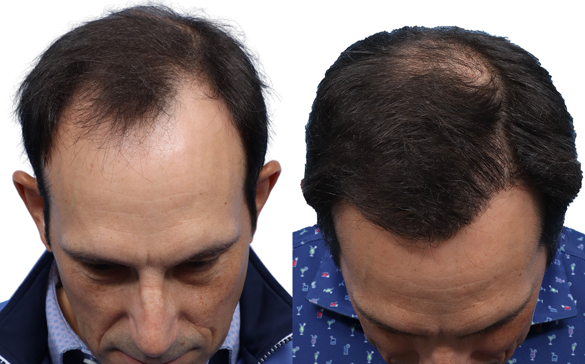 FUE Hair Transplant Before & After Gallery - Patient 113936 - Image 2