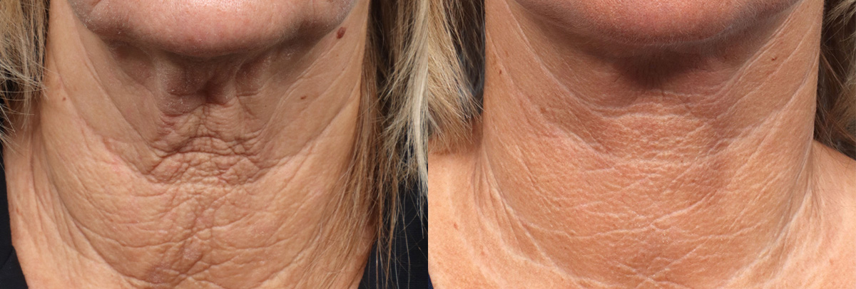 Deep Plane Facelift Before & After Gallery - Patient 289397 - Image 1