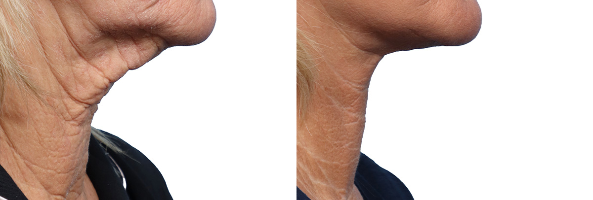 Deep Plane Facelift Before & After Gallery - Patient 289397 - Image 2