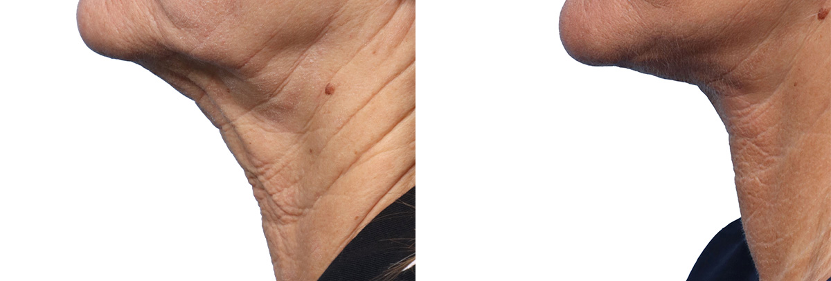 Deep Plane Facelift Before & After Gallery - Patient 289397 - Image 3