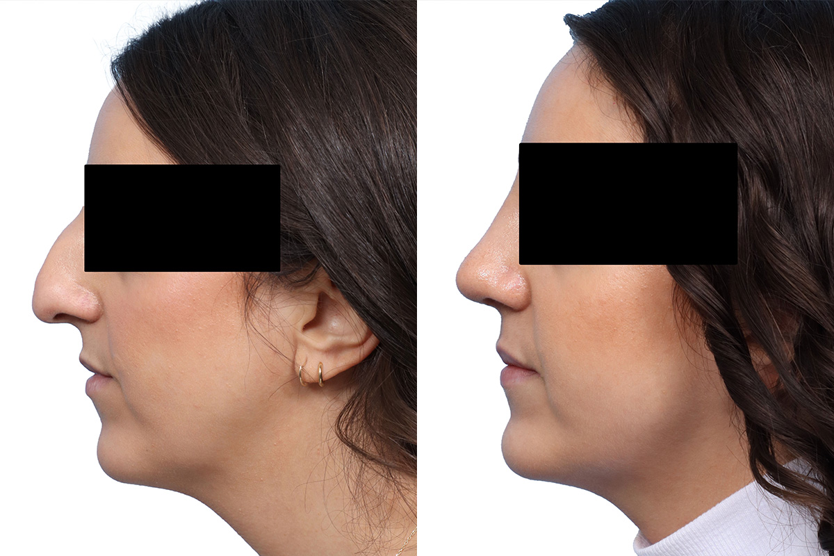Rhinoplasty Before & After Gallery - Patient 802024 - Image 2