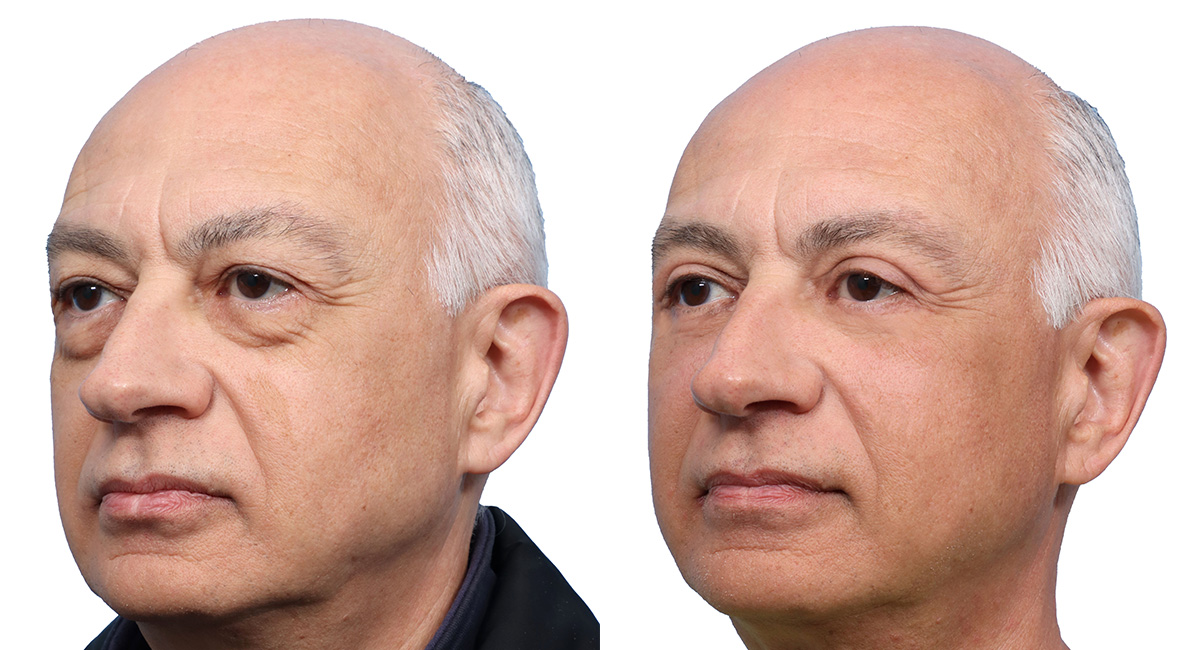 Blepharoplasty (Eyelid Surgery) Before & After Gallery - Patient 163451 - Image 2