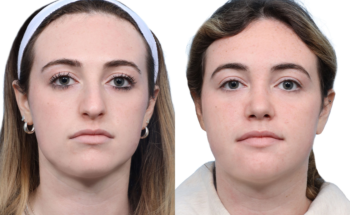 Rhinoplasty Before & After Gallery - Patient 251424 - Image 3