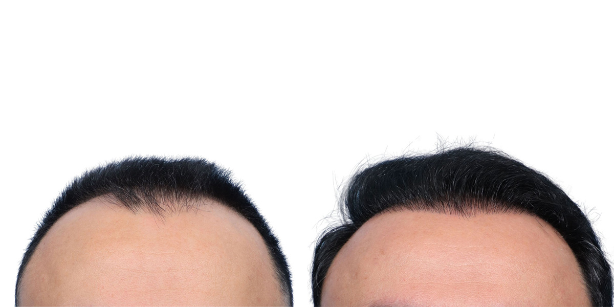 FUE Hair Transplant Before & After Gallery - Patient 280259 - Image 1