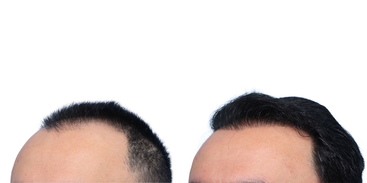 FUE Hair Transplant Before & After Gallery - Patient 280259 - Image 3