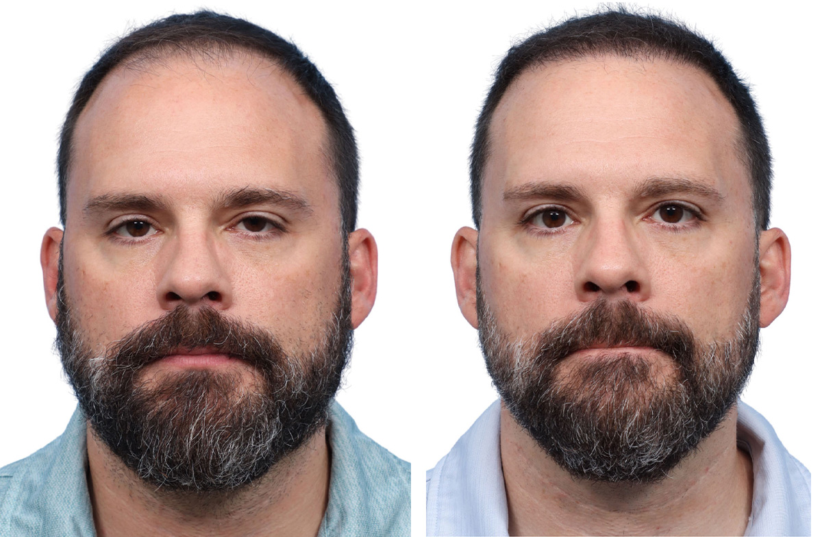 FUE Hair Transplant Before & After Gallery - Patient 366516 - Image 1