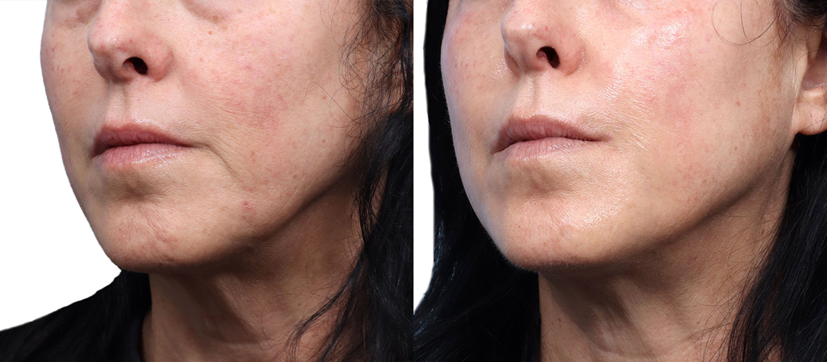 Morpheus8® Before & After Gallery - Patient 335746 - Image 3