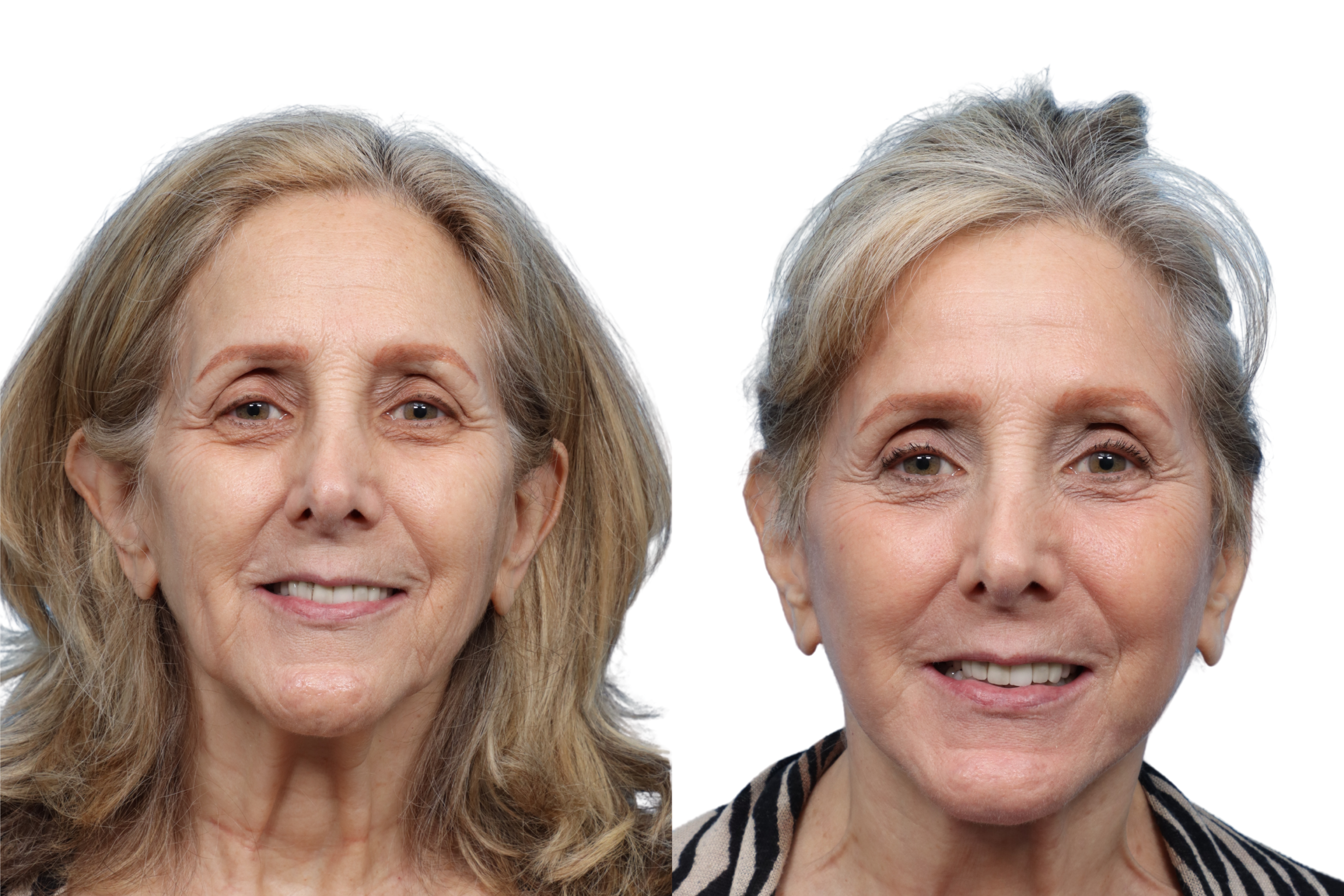 Facial Fat Transfer Before & After Gallery - Patient 217344 - Image 1
