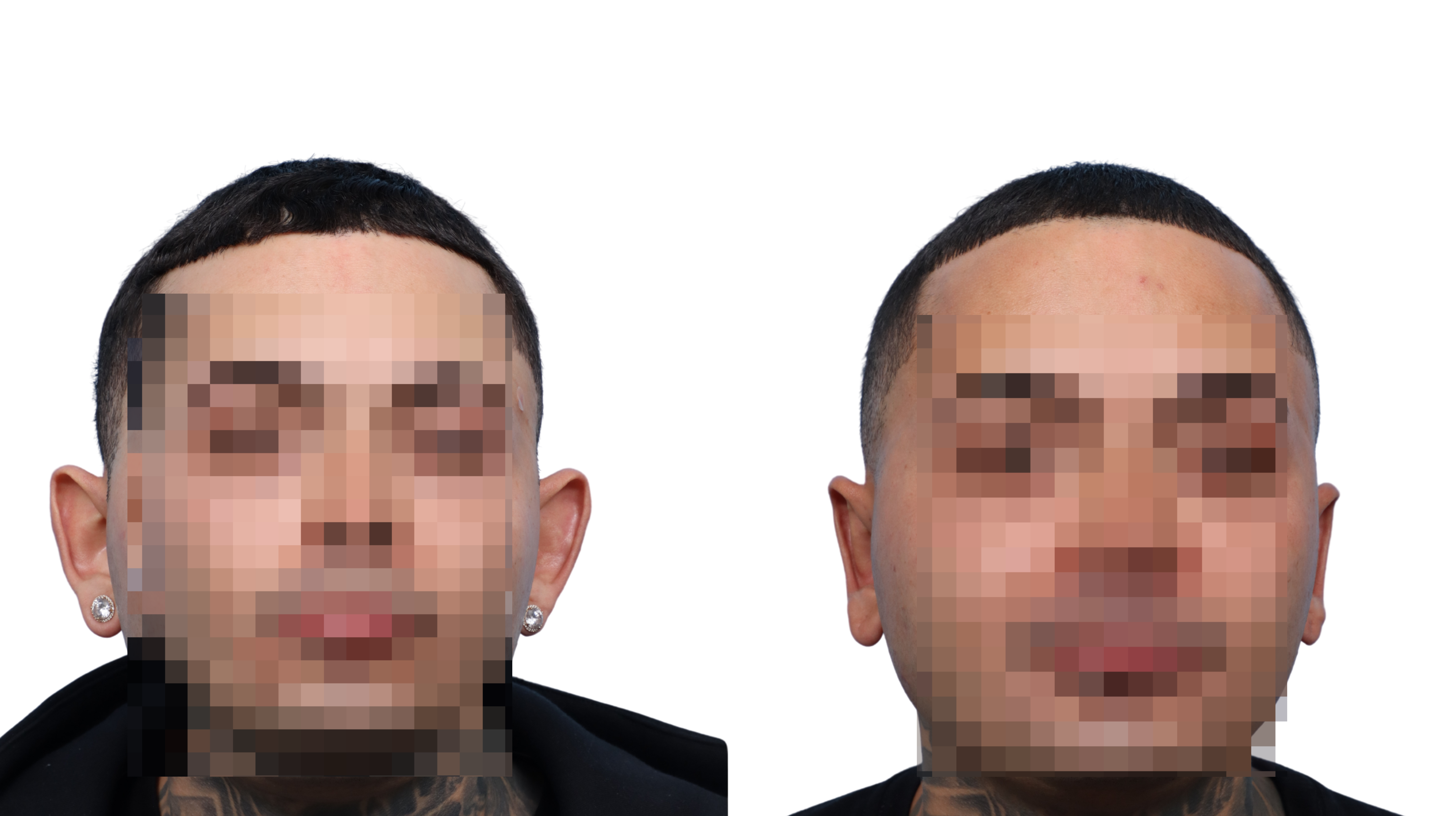 Otoplasty (Ear Surgery) Before & After Gallery - Patient 313508 - Image 2