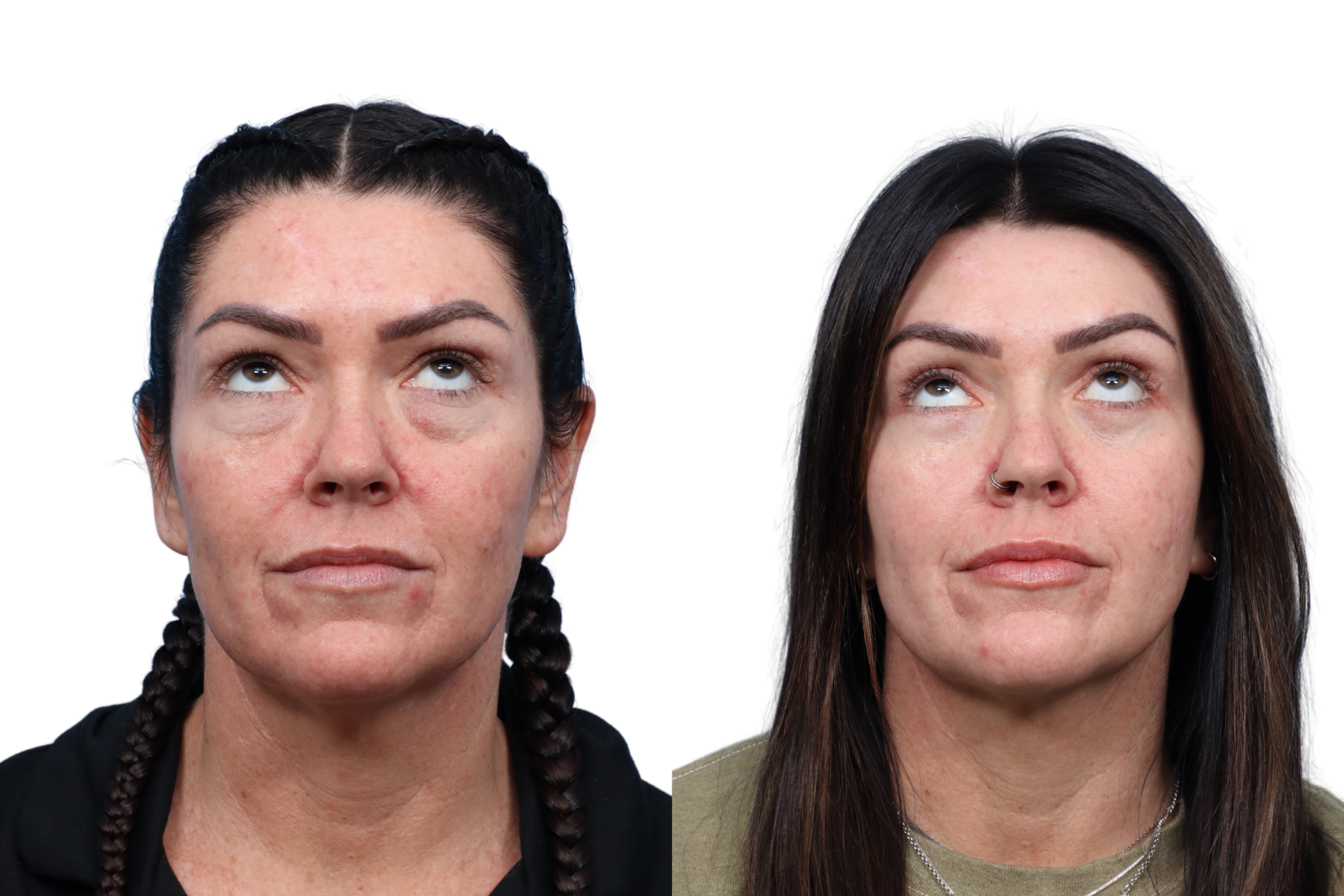 Blepharoplasty (Eyelid Surgery) Before & After Gallery - Patient 295877 - Image 2
