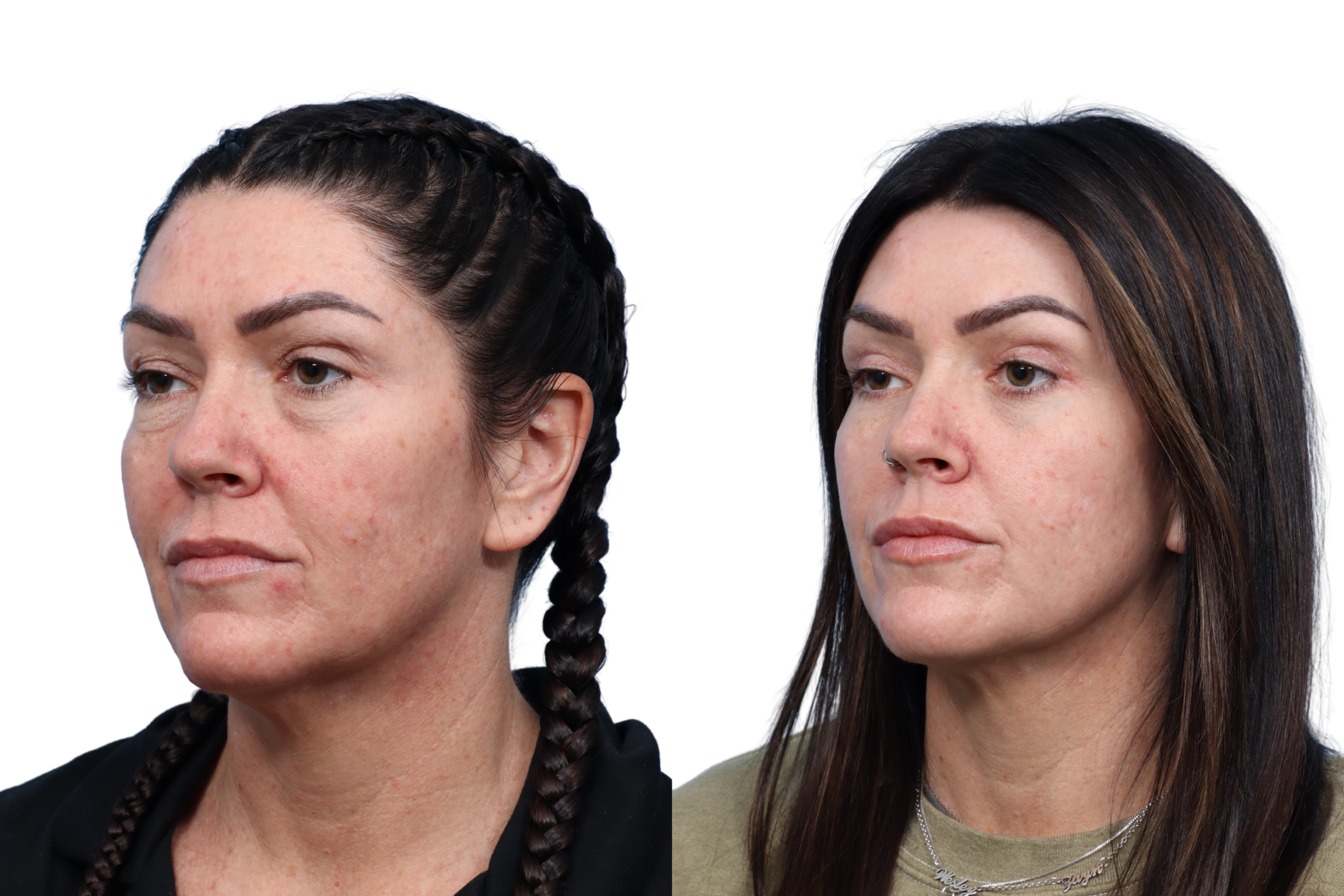 Blepharoplasty (Eyelid Surgery) Before & After Gallery - Patient 295877 - Image 3