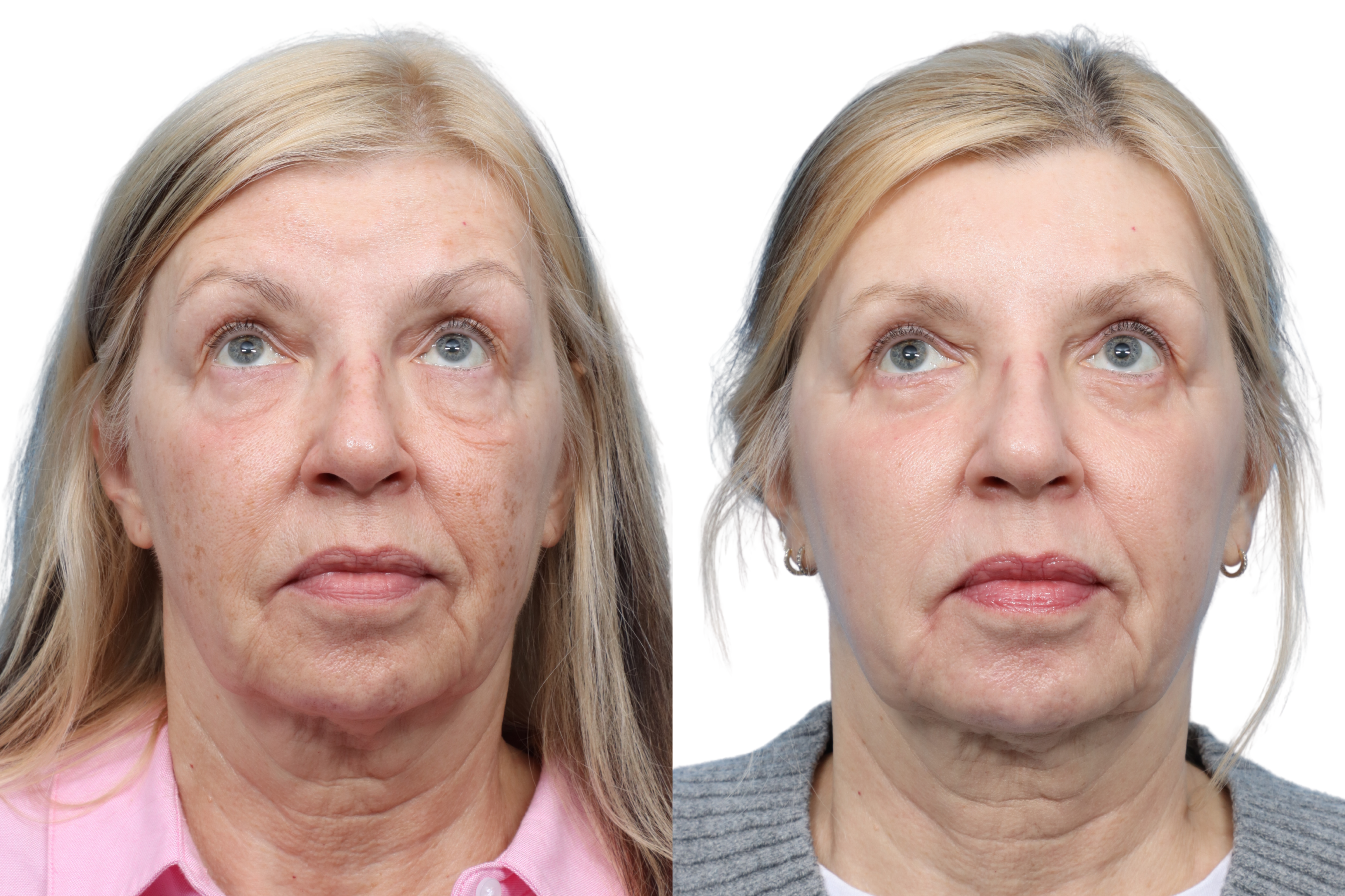 CO2 Laser Before & After Gallery - Patient 185311 - Image 2