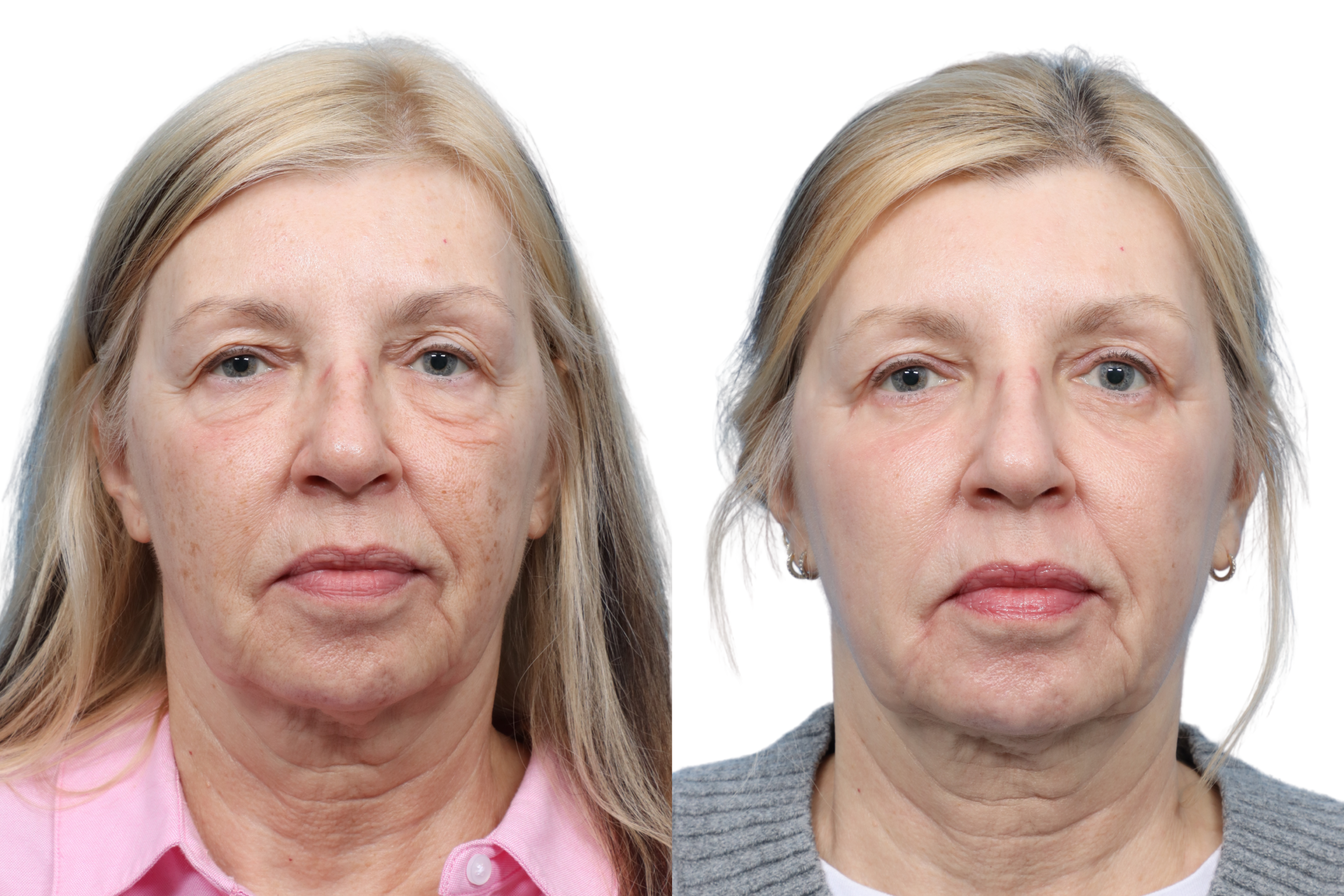 CO2 Laser Before & After Gallery - Patient 185311 - Image 3