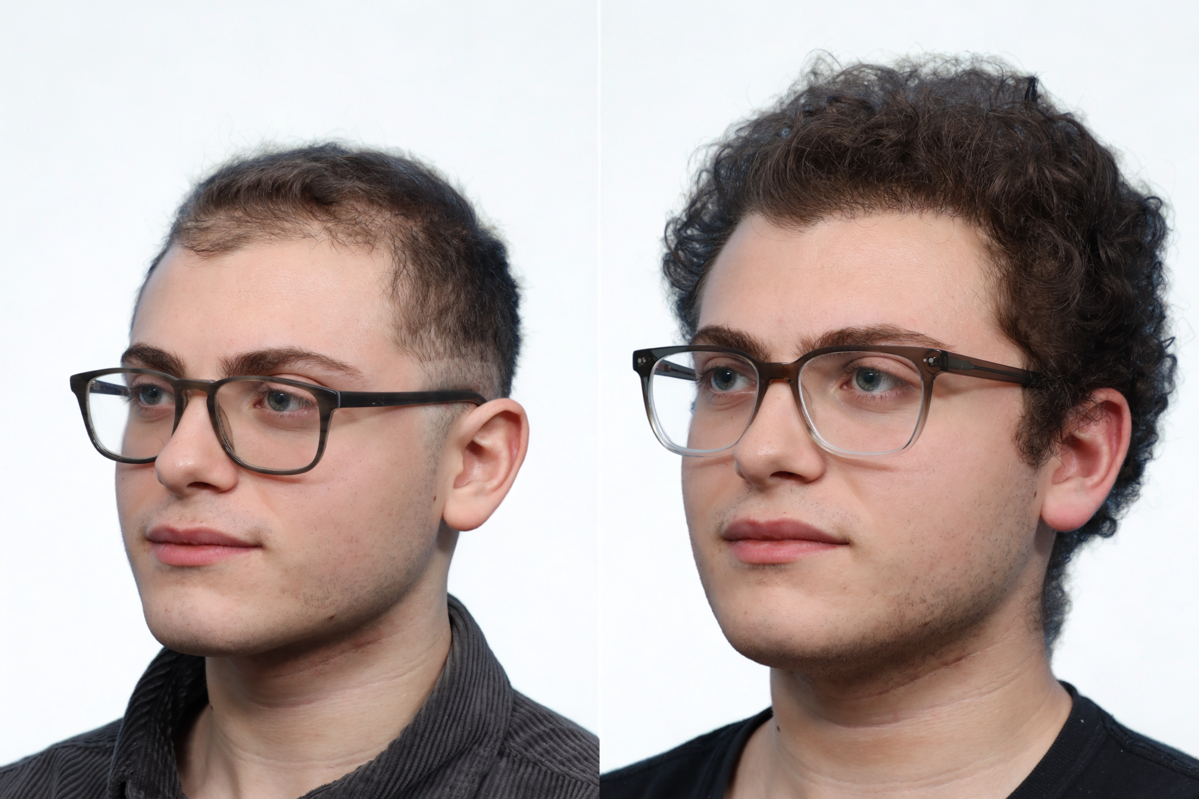 FUE Hair Transplant Before & After Gallery - Patient 353054 - Image 3