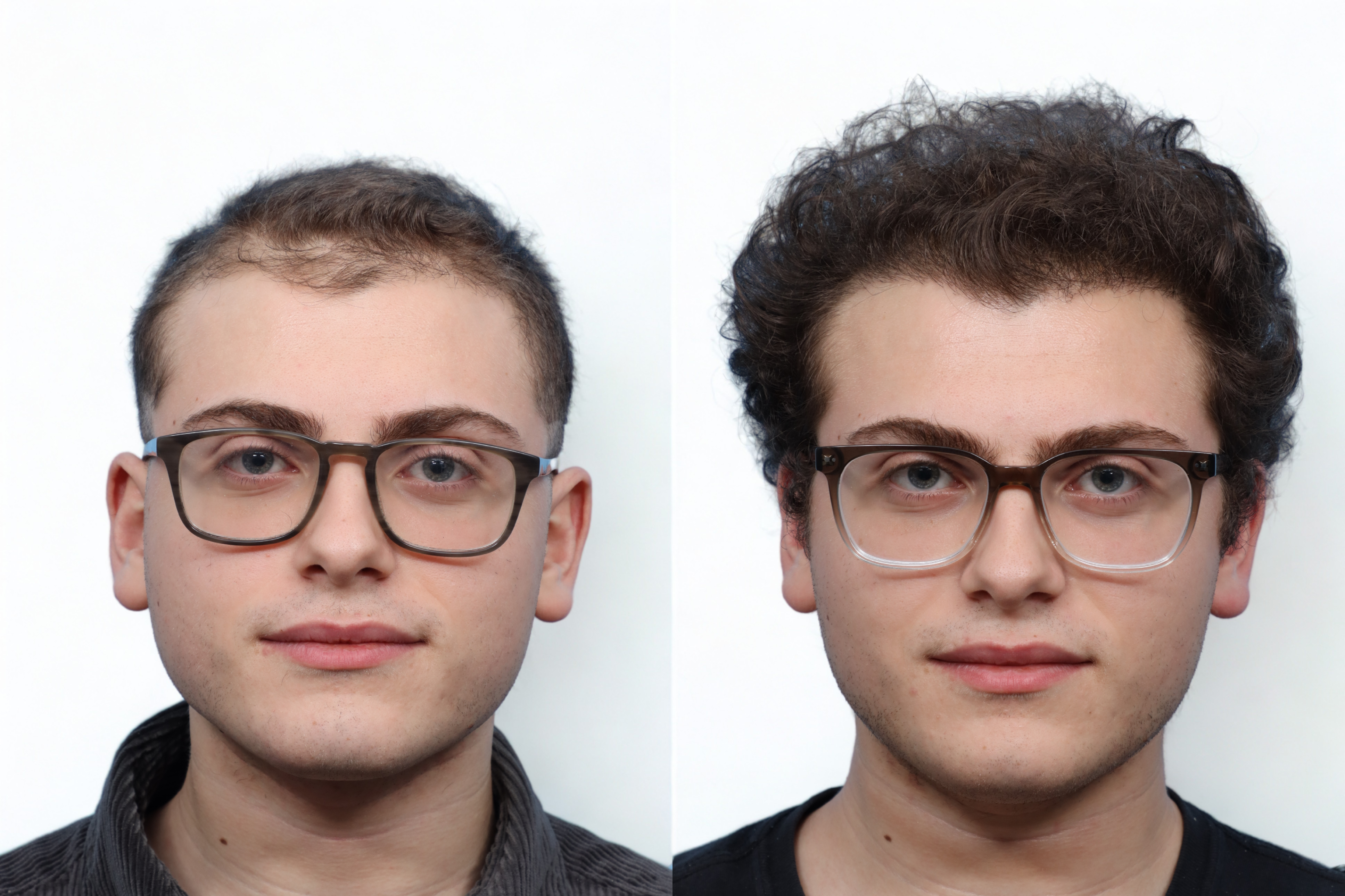 FUE Hair Transplant Before & After Gallery - Patient 353054 - Image 1