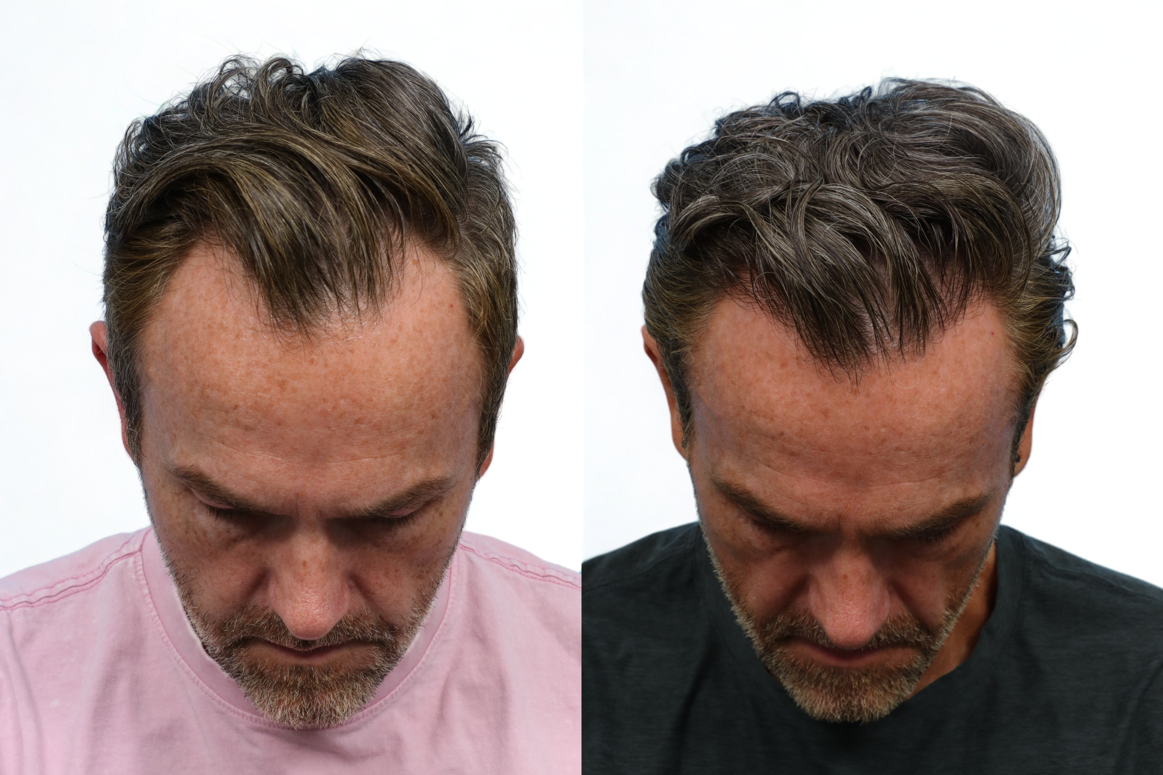 FUE Hair Transplant Before & After Gallery - Patient 565134 - Image 1
