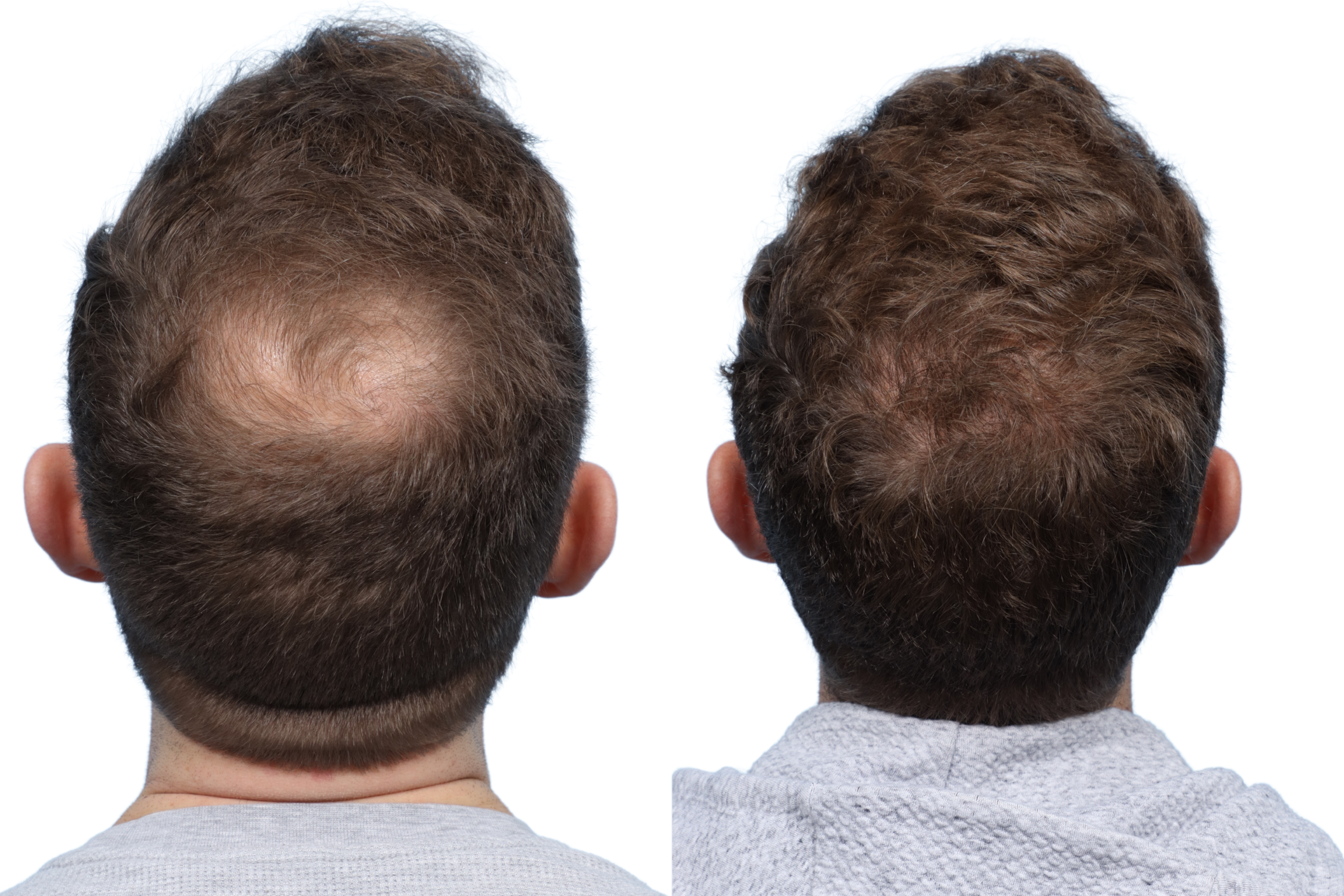 FUE Hair Transplant Before & After Gallery - Patient 304971 - Image 1