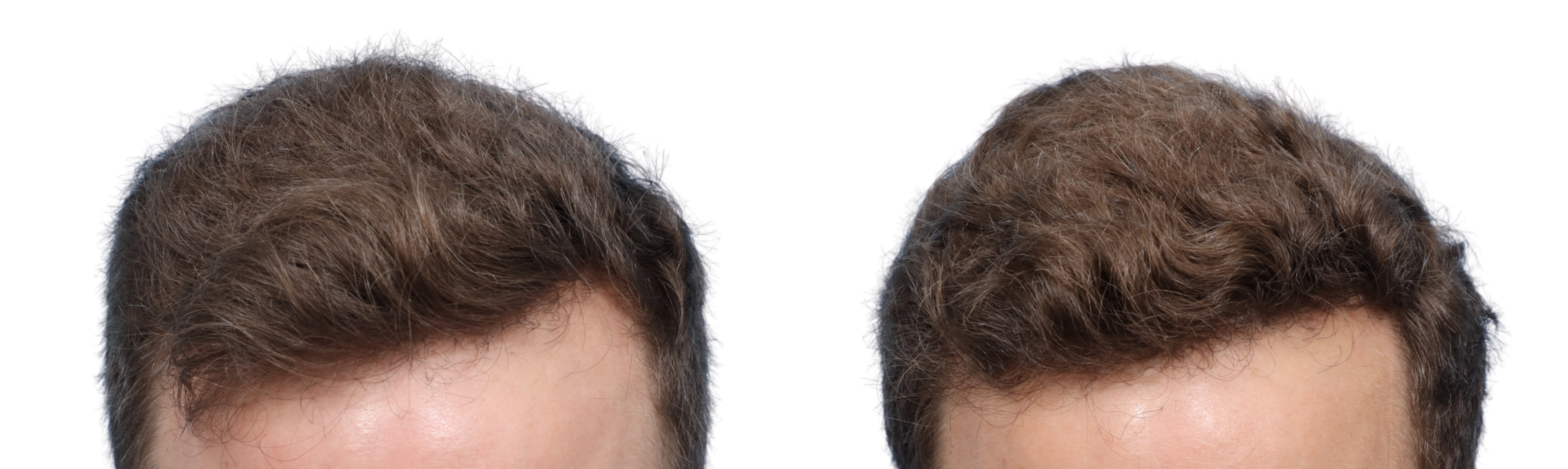 FUE Hair Transplant Before & After Gallery - Patient 304971 - Image 2