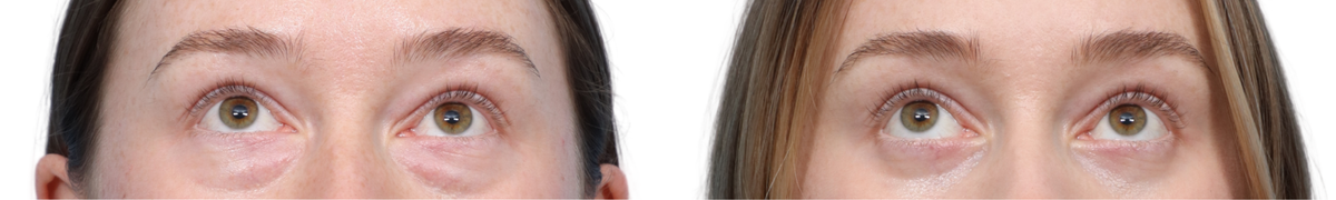 Blepharoplasty (Eyelid Surgery) Before & After Gallery - Patient 884897 - Image 1