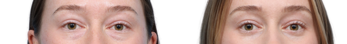 Blepharoplasty (Eyelid Surgery) Before & After Gallery - Patient 884897 - Image 2