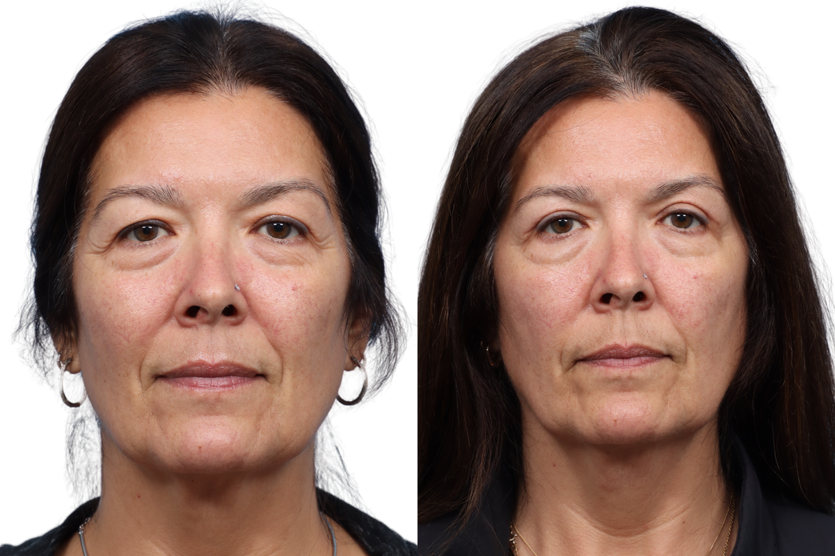 Blepharoplasty (Eyelid Surgery) Before & After Gallery - Patient 522247 - Image 1
