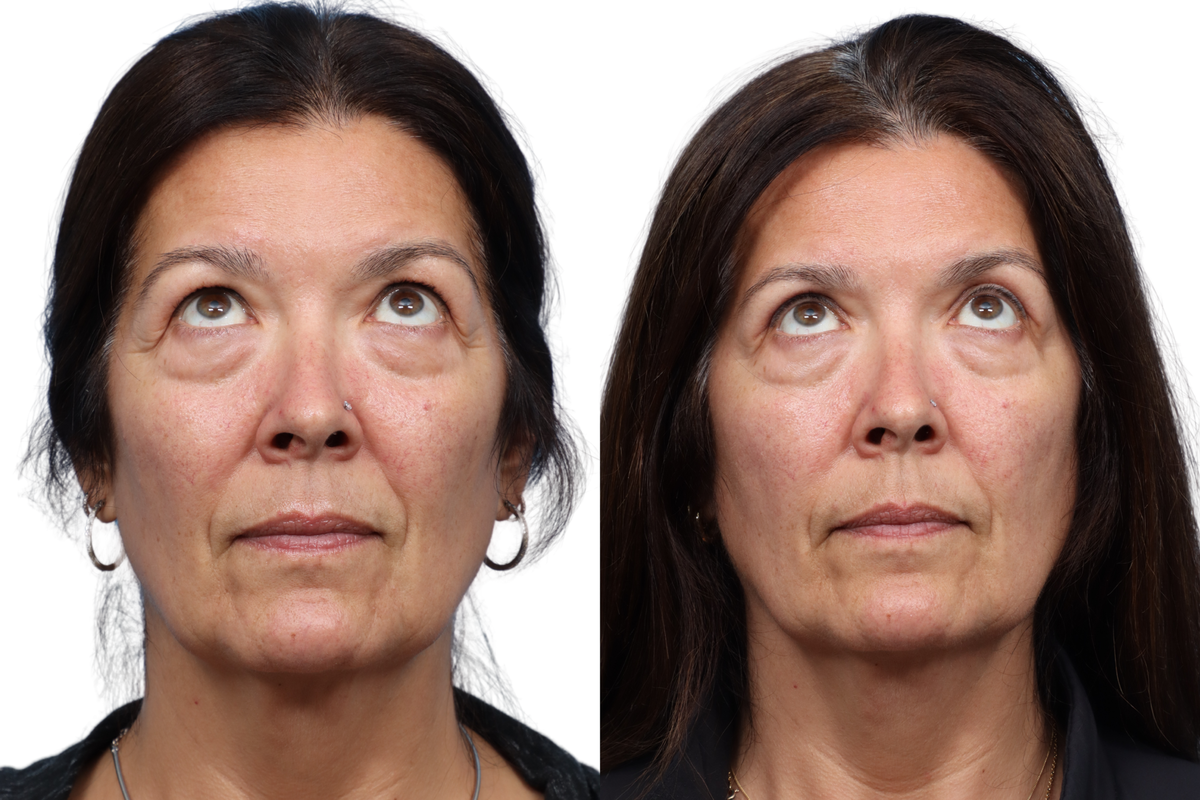 Blepharoplasty (Eyelid Surgery) Before & After Gallery - Patient 522247 - Image 2