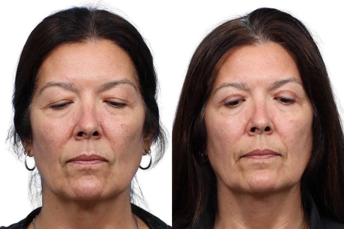 Blepharoplasty (Eyelid Surgery) Before & After Gallery - Patient 522247 - Image 3