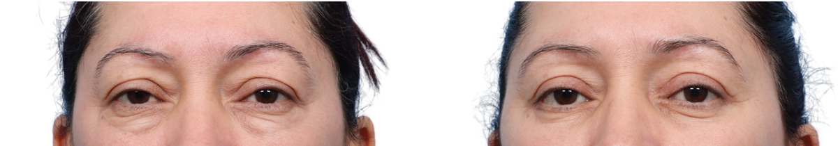 Blepharoplasty (Eyelid Surgery) Before & After Gallery - Patient 496545 - Image 2